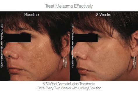 Dermalinfusion Silkpeel Discovery Laser Skin Care Clinic