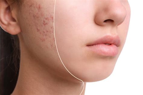 Management Of Acne Vulgaris What Are Your Treatment Options Angeline