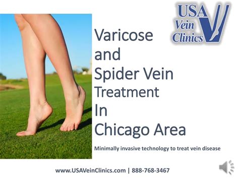 Ppt Usa Vein Clinics Vein Treatment In Chicago Il Powerpoint