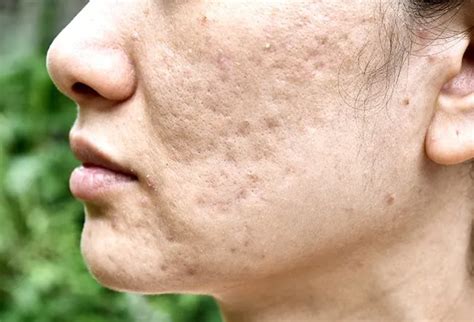 How To Get Rid Of Acne Scars And How Long Does It Take To Heal