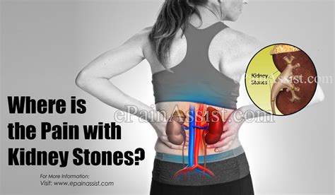 Where Is The Pain With Kidney Stones