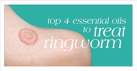 Top 4 Essential Oils To Treat Ringworm