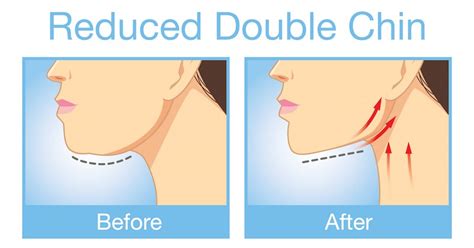 5 Proven Tips For Double Chin Removal How To Get Rid Of Double Chin