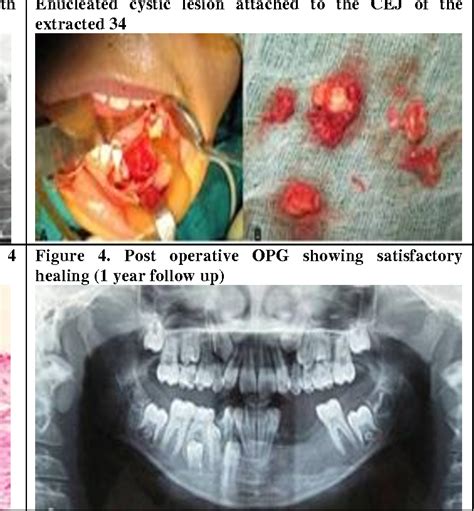 A Case Report Of Dentigerous Cyst Associated With Mandibular Premolar
