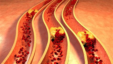 What Are The Causes And Symptoms Of Arteriosclerosis