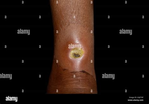 Diabetic Ulcer In Leg Of Asian Patient Poor Wound Healing Isolated