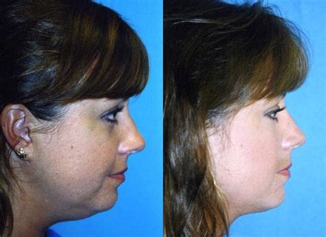 Patient 122406502 Laser Assisted Weekend Neck Lift Before And After