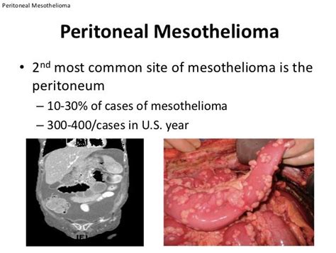 Peritoneal Mesothelioma Symptoms Life Expectancy Peritoneal Cancer