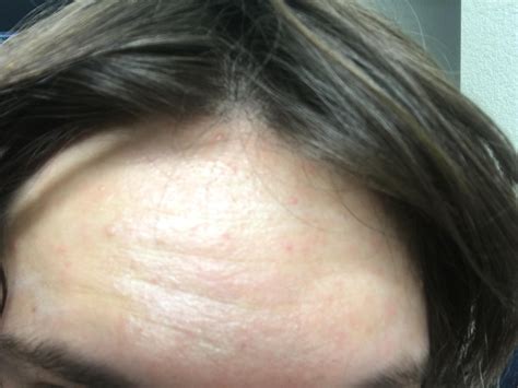 Skin Concerns I Have These Lines On My Forehead And Im 20 They Seem