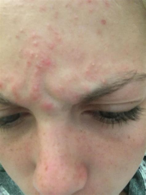 Small Bumps All Over Forehead General Acne Discussion