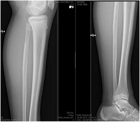 Proximal fibular stress fractures in children and adolescents, what