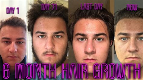 6 Month Hair Growth Timelapse Youtube
