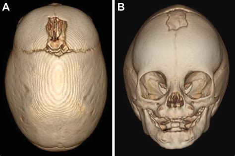 Pediatric Craniosynostosis Uf Pediatric Neurosurgery Pediatric