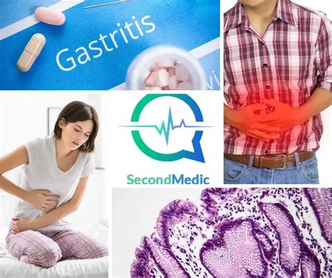 Gastritis Causes Symptoms Diagnosis And Treatment