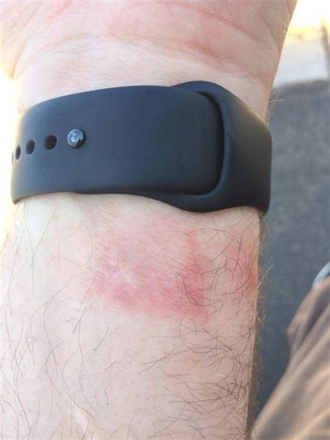 Apple Watch And Fitbit Owners Complain Of Rashes Ubergizmo