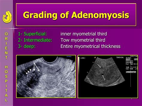 Ppt Adenomyosis And Infertility Powerpoint Presentation Free Download