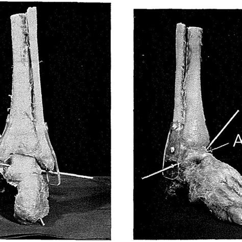 Talocrural Joint Axis A And Subtalar Joint Axis B Of Human Foot