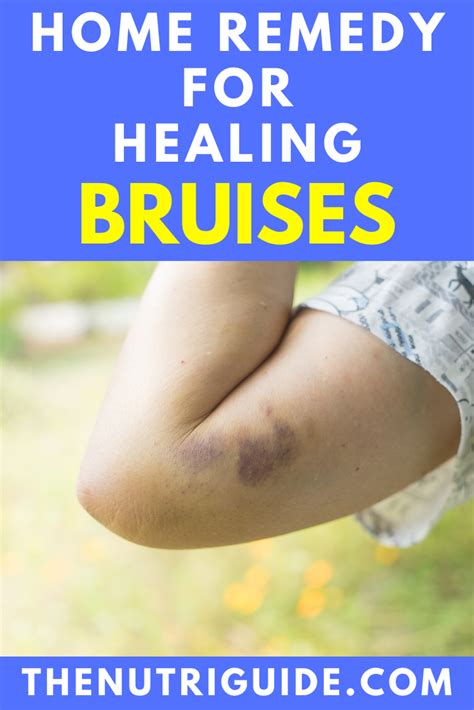 Home Remedy For Healing Bruises How To Get Rid Of Bruises Naturally