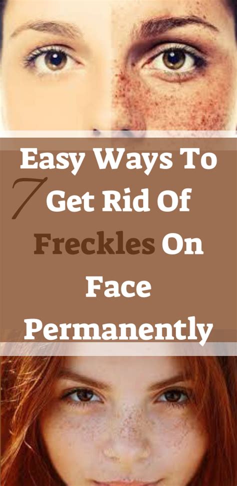 Easy Ways To Get Rid Of Freckles On Face Permanently Getting Rid Of