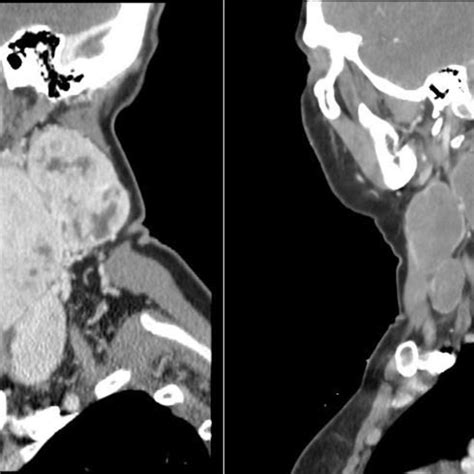 Sagittal Contrast Enhanced Computed Tomography Scans Prelenvatinib