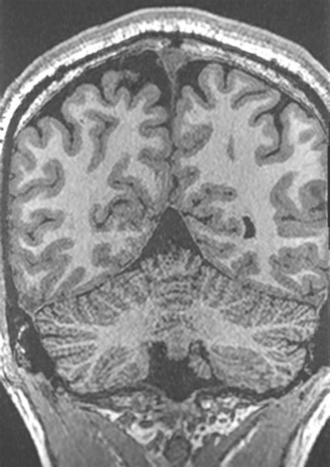 Ge Research Begins Mild Traumatic Brain Injury Tbi Mri Study With