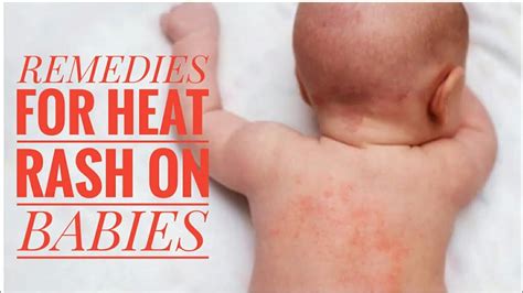 Super Mom Ep 74 Remedies For Heat Rashes On Babies Youtube