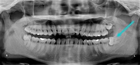 Is It Necessary To Have Your Wisdom Teeth Removed Identity Dentistry