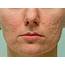 Acne Treatment In Exeter NH  Specialist