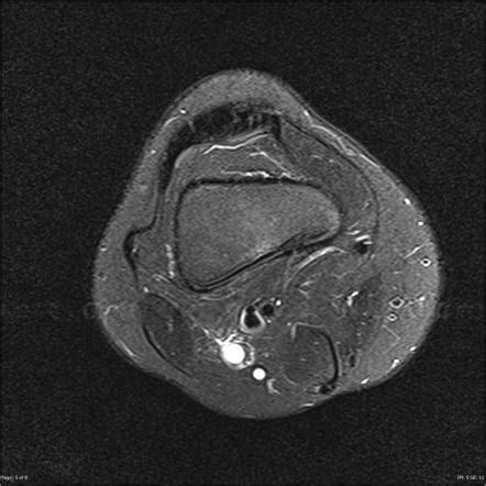 Intraneural Ganglion Cyst Radiology Case Radiopaedia Org