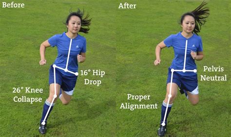 Who Needs Knees Why Acl Injury Prevention Matters Stride Physio