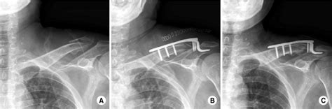 A Neer Type Iia Fracture Of Clavicle In A 39 Year Old Man B
