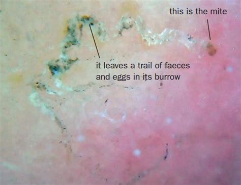 When To See A Doctor For Scabies Liinedesign