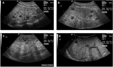 Polycystic Kidney Disease Ultrasound