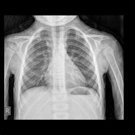 Bronchitis Chest X Ray Radiology Asthma Lung Disease