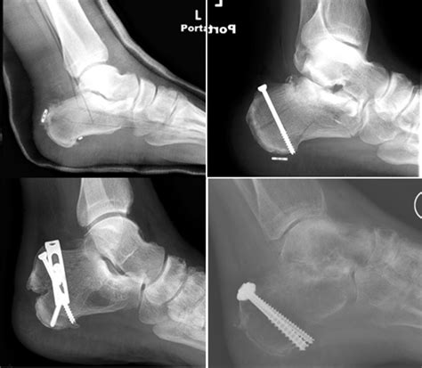 Avulsion Fractures Of The Calcaneal Tuberosity A Single Cen Jaaos