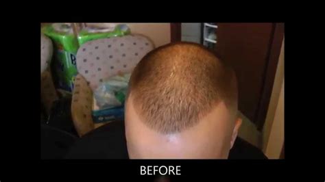 Fue Hair Transplant In Toronto Shaved Head 8 Months After Surehair