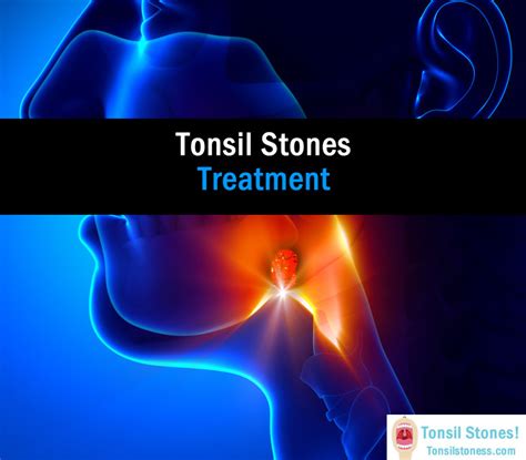 Natural Home Remedies To Cure Tonsil Stones Top 7 Tips