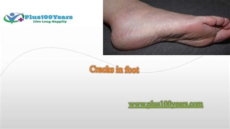 Cracked Feet Symptomscausestreatment