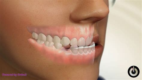Lower 1st Premolar Extraction Dental Braces Temecula Valley Ca