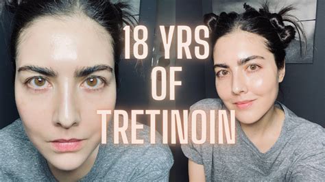 Not Seeing Results With Retin A Tretinoin Watch This Before You Quit