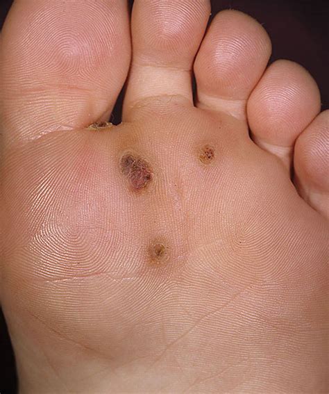 List 100 Pictures Black Spot On Bottom Of Big Toe Stunning 10 2023