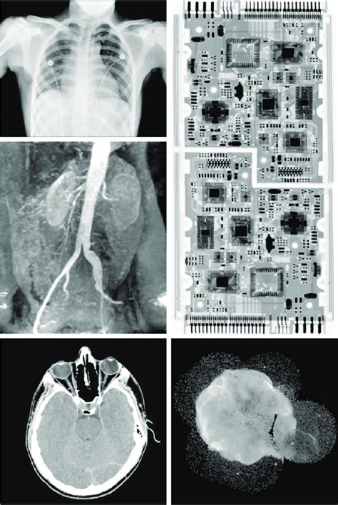 7 Examples Of X Ray Imaging A Chest X Ray B Aortic Angiogram C