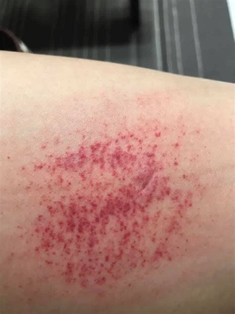 What Could Be The Cause Of Recurring Itchy Thigh Rashes Photo Human