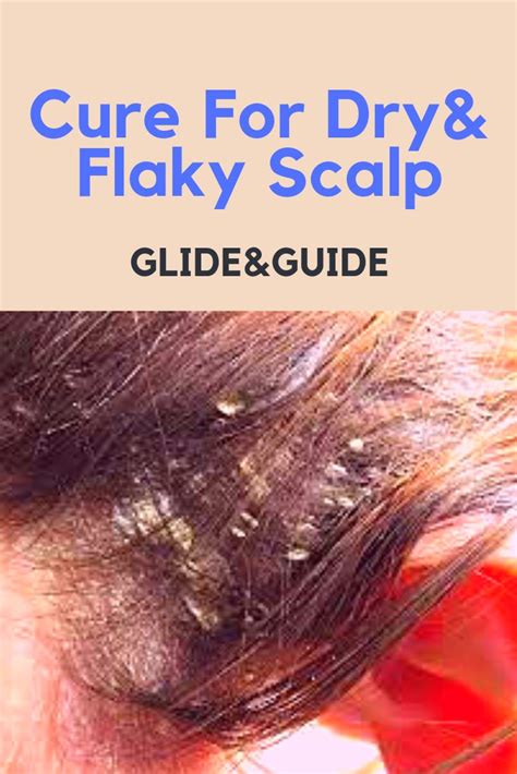 Cure For Dry Flaky Scalp Glideandguide Flaky Scalp Dry Flaky Scalp