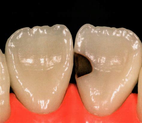 Class Iii Composite Restoration Palatal Access Dental Esthetics