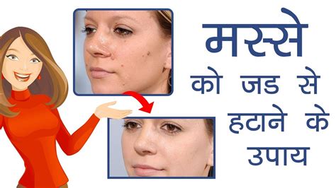 मस्से को जड़ से हटाने के उपाय 100 Effective Best Wart Removal