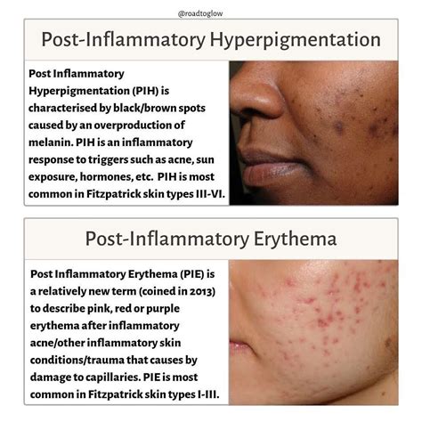 Roadtoglows Instagram Post 🔍 Post Inflammatory Hyperpigmentation Vs