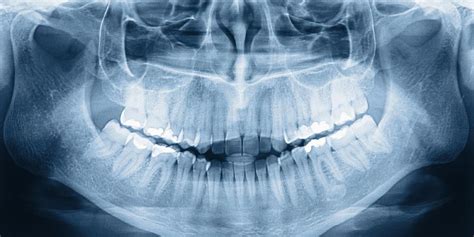 Types Of Dental X Rays Dr Jerry Maymi Associates