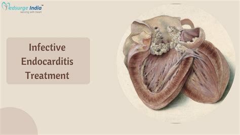 Infective Endocarditis Treatment Cost In India Medsurge India