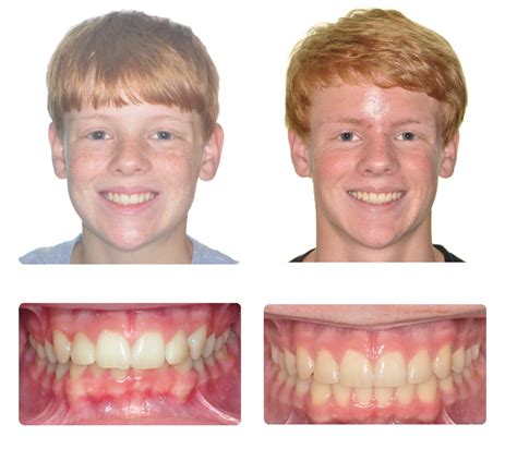 Before And After Klein Walker Orthodontics